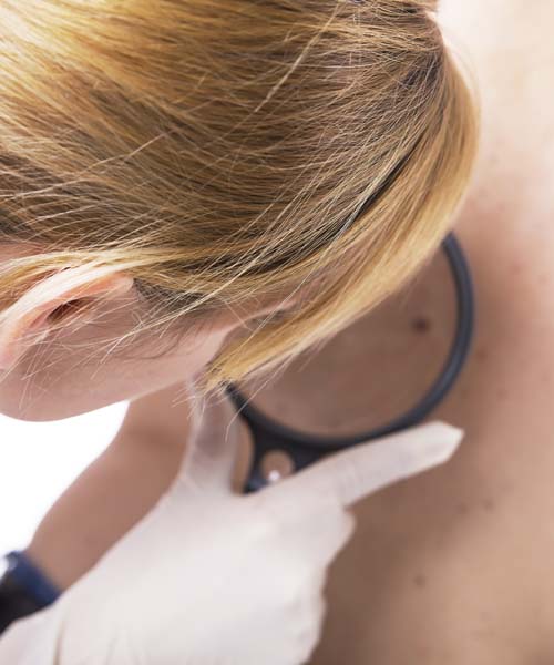 Vorsorgeuntersuchung - Hautkrebs Screening